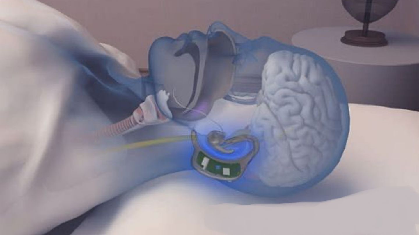VVfly Anti-Snoring Device